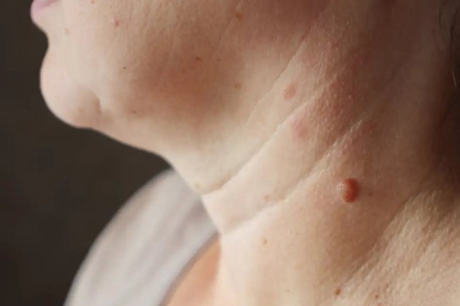 त्वचा में मौजूद मस्सों से कैसे पाएं राहत, जानिए टिप्स