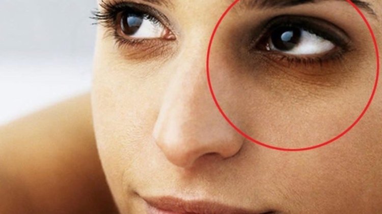 आंखों के आस-पास पड़ी इन झुर्रियों से दिख सकते हैं बूढ़े, जानें रोकने के उपाय